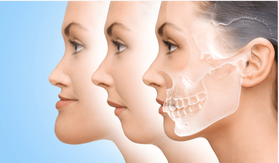 Cirugía ortognática maxilar